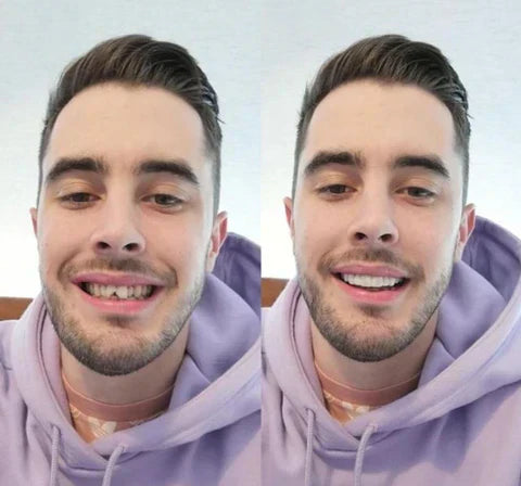 NovaBright Snap-On Veneers For Top And Bottom Teeth Custom Fit Removable Smile Solution