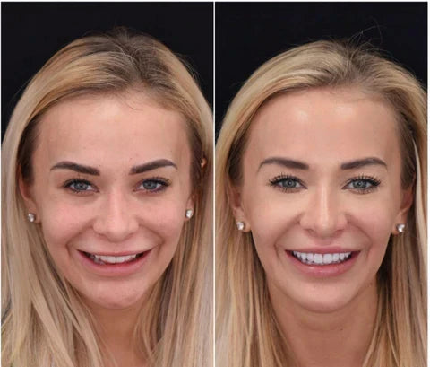 NovaBright Snap-On Veneers For Top And Bottom Teeth Custom Fit Removable Smile Solution